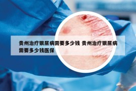 貴州治療銀屑病需要多少錢(qián) 貴州治療銀屑病需要多少錢(qián)醫(yī)保