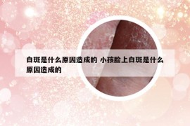 白斑是什么原因造成的 小孩臉上白斑是什么原因造成的