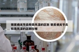 銀屑病關(guān)節(jié)炎和類風(fēng)濕的區(qū)別 銀屑病關(guān)節(jié)炎和類風(fēng)濕的區(qū)別在哪