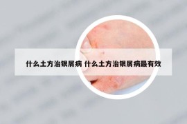 什么土方治銀屑病 什么土方治銀屑病最有效