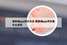 銀屑病pga評分方法 銀屑病pga評分是什么意思