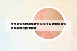 成都那家醫(yī)院看牛皮癬好不好治 成都治療銀屑病最好的醫(yī)生排名