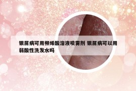 銀屑病可用柳烯酸溶液噴霧劑 銀屑病可以用弱酸性洗發(fā)水嗎