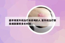 最早用紫外線治療銀屑病的人 紫外線治療銀屑病需要照多長(zhǎng)時(shí)間