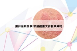 用蒜治銀屑病 銀屑病用大蒜有效果嗎