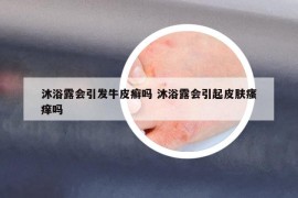 沐浴露會(huì)引發(fā)牛皮癬嗎 沐浴露會(huì)引起皮膚瘙癢嗎