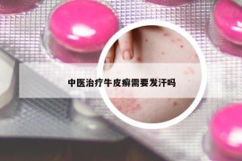 中醫(yī)治療牛皮癬需要發(fā)汗嗎