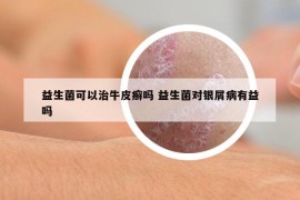 益生菌可以治牛皮癬嗎 益生菌對(duì)銀屑病有益嗎