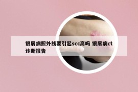 銀屑病照外線要引起scc高嗎 銀屑病ct診斷報告