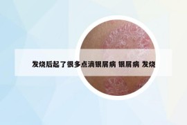 發(fā)燒后起了很多點(diǎn)滴銀屑病 銀屑病 發(fā)燒