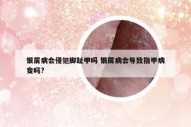 銀屑病會侵犯腳趾甲嗎 銀屑病會導(dǎo)致指甲病變嗎?