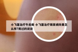 小飛蓬治療牛皮癬 小飛蓬治療銀屑病效果怎么樣?用過的說說