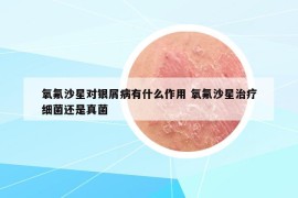 氧氟沙星對銀屑病有什么作用 氧氟沙星治療細(xì)菌還是真菌