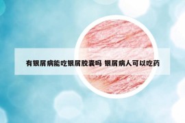 有銀屑病能吃銀屑膠囊嗎 銀屑病人可以吃藥