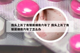 我頭上長(zhǎng)了有銀屑病有六年了 我頭上長(zhǎng)了有銀屑病有六年了怎么辦