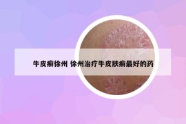 牛皮癬徐州 徐州治療牛皮膚癬最好的藥