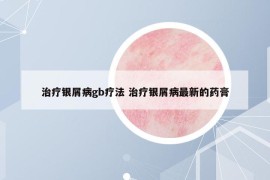 治療銀屑病gb療法 治療銀屑病最新的藥膏