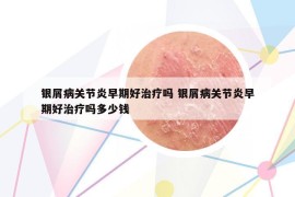 銀屑病關(guān)節(jié)炎早期好治療嗎 銀屑病關(guān)節(jié)炎早期好治療嗎多少錢