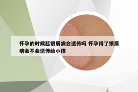 懷孕的時候起銀屑病會遺傳嗎 懷孕得了銀屑病會不會遺傳給小孩