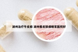 湖州治療牛皮癬 湖州看皮膚病哪家醫(yī)院好