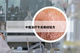 中醫(yī)治療牛皮癬經(jīng)驗(yàn)方