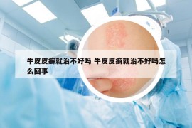 牛皮皮癬就治不好嗎 牛皮皮癬就治不好嗎怎么回事