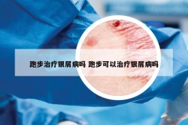 跑步治療銀屑病嗎 跑步可以治療銀屑病嗎