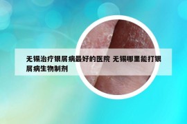 無錫治療銀屑病最好的醫(yī)院 無錫哪里能打銀屑病生物制劑