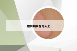 銀屑病長(zhǎng)在龜頭上