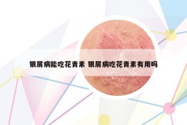 銀屑病能吃花青素 銀屑病吃花青素有用嗎