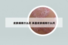 皮膚病用什么藥 真菌皮膚病用什么藥