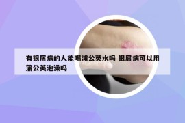 有銀屑病的人能喝浦公英水嗎 銀屑病可以用蒲公英泡澡嗎