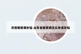 濟(jì)南銀屑病補(bǔ)貼 山東省銀屑病怎么申請補(bǔ)貼