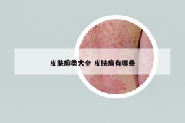 皮膚癬類大全 皮膚癬有哪些