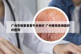 廣州市哪里里看牛皮癬好 廣州看銀屑病最好的醫(yī)院