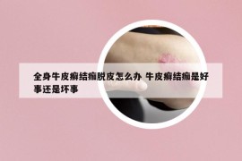 全身牛皮癬結(jié)痂脫皮怎么辦 牛皮癬結(jié)痂是好事還是壞事
