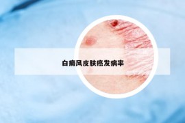 白癜風(fēng)皮膚癌發(fā)病率
