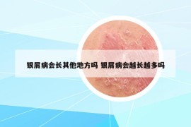 銀屑病會(huì)長(zhǎng)其他地方嗎 銀屑病會(huì)越長(zhǎng)越多嗎