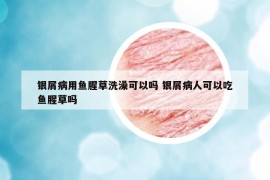 銀屑病用魚腥草洗澡可以嗎 銀屑病人可以吃魚腥草嗎
