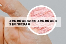 兒童白顛瘋病可以治愈嗎 兒童白顛瘋病可以治愈嗎?要花多少錢