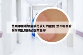 蘭州哪里看銀屑病比較好的醫(yī)院 蘭州哪里看銀屑病比較好的醫(yī)院最好