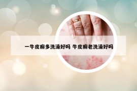 一牛皮癬多洗澡好嗎 牛皮癬老洗澡好嗎