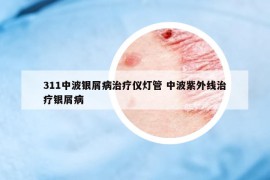 311中波銀屑病治療儀燈管 中波紫外線治療銀屑病