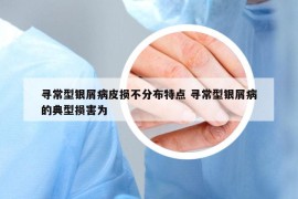 尋常型銀屑病皮損不分布特點(diǎn) 尋常型銀屑病的典型損害為