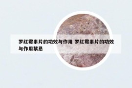 羅紅霉素片的功效與作用 羅紅霉素片的功效與作用禁忌