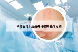 手淫會得牛皮癬嗎 手淫導致牛皮癬