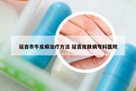 延吉市牛皮癬治療方法 延吉皮膚病?？漆t(yī)院