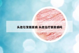 頭孢引發(fā)銀屑病 頭孢治療銀屑病嗎