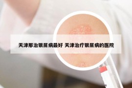 天津那治銀屑病最好 天津治療銀屑病的醫(yī)院
