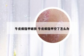 牛皮癬指甲破損 牛皮癬指甲空了怎么辦